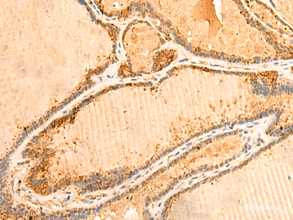 Immunohistochemistry of paraffin-embedded Human thyroid cancer tissue using PPM1B Polyclonal Antibody at dilution of 1:50(×200)