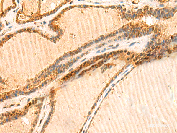 Immunohistochemistry of paraffin-embedded Human thyroid cancer tissue using LYZL1 Polyclonal Antibody at dilution of 1:50(×200)