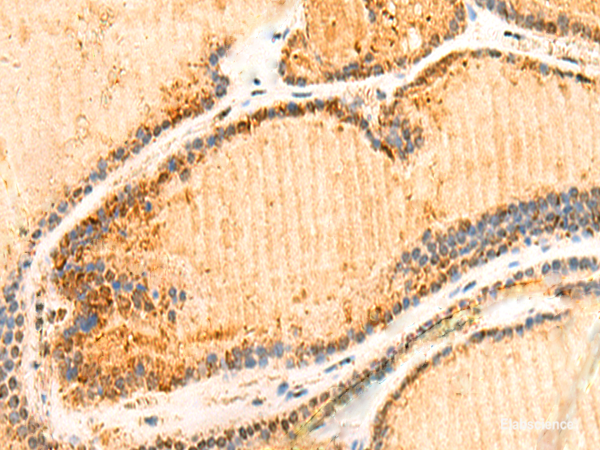 Immunohistochemistry of paraffin-embedded Human thyroid cancer tissue using ZNF581 Polyclonal Antibody at dilution of 1:50(×200)
