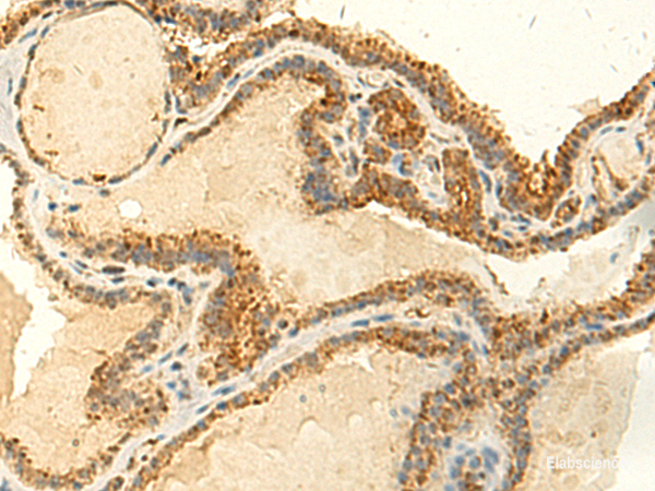 Immunohistochemistry of paraffin-embedded Human thyroid cancer tissue using MTHFS Polyclonal Antibody at dilution of 1:50(×200)