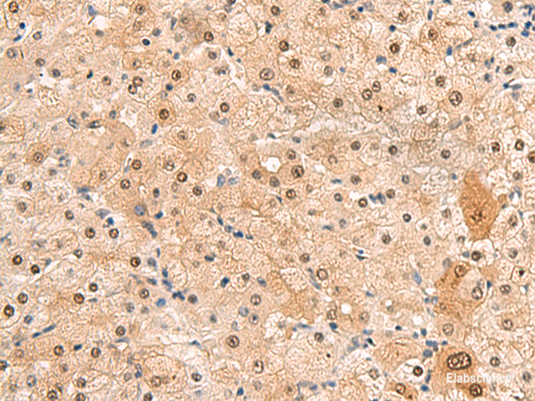 Immunohistochemistry of paraffin-embedded Human liver cancer tissue using HEBP2 Polyclonal Antibody at dilution of 1:60(×200)