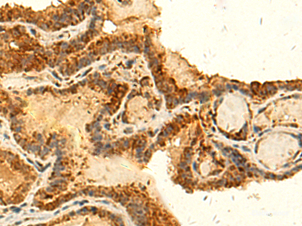 Immunohistochemistry of paraffin-embedded Human thyroid cancer tissue using HS1BP3 Polyclonal Antibody at dilution of 1:50(×200)