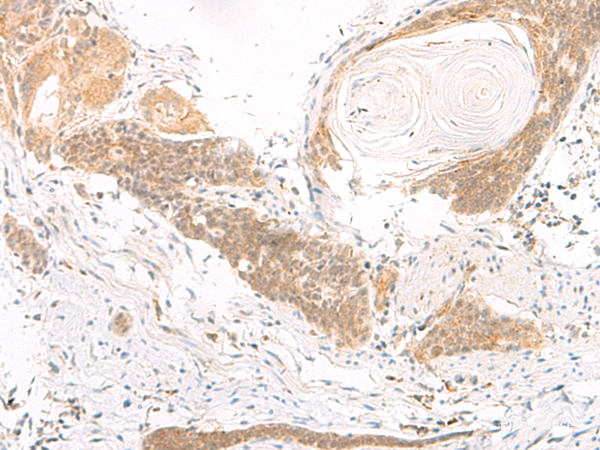 Immunohistochemistry of paraffin-embedded Human esophagus cancer tissue using DGCR6L Polyclonal Antibody at dilution of 1:70(×200)