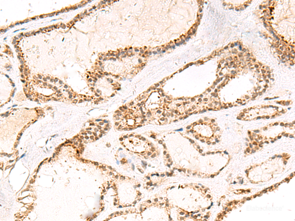 Immunohistochemistry of paraffin-embedded Human thyroid cancer tissue using DCAF10 Polyclonal Antibody at dilution of 1:55(×200)
