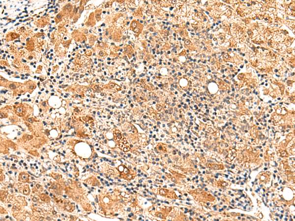 Immunohistochemistry of paraffin-embedded Human liver cancer tissue using PAFAH1B2 Polyclonal Antibody at dilution of 1:50(×200)