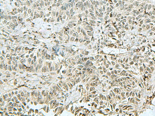 Immunohistochemistry of paraffin-embedded Human ovarian cancer tissue using THTPA Polyclonal Antibody at dilution of 1:90(×200)