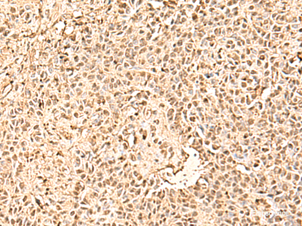 Immunohistochemistry of paraffin-embedded Human ovarian cancer tissue using SMNDC1 Polyclonal Antibody at dilution of 1:50(×200)