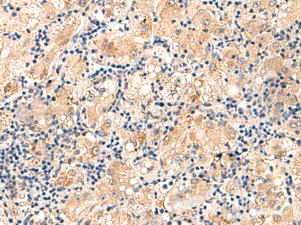 Immunohistochemistry of paraffin-embedded Human liver cancer tissue using MRPL16 Polyclonal Antibody at dilution of 1:60(×200)