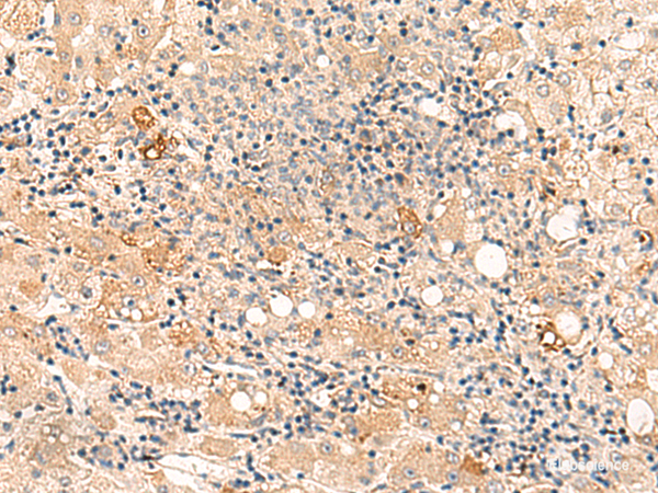 Immunohistochemistry of paraffin-embedded Human liver cancer tissue using SULT4A1 Polyclonal Antibody at dilution of 1:50(×200)