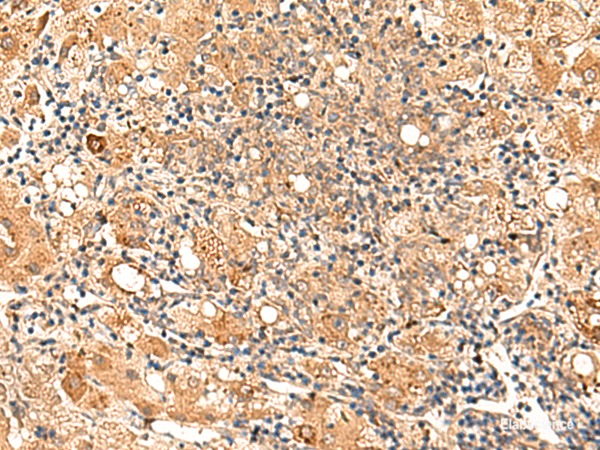 Immunohistochemistry of paraffin-embedded Human liver cancer tissue using GALNT12 Polyclonal Antibody at dilution of 1:70(×200)