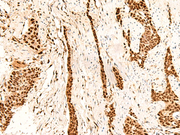 Immunohistochemistry of paraffin-embedded Human esophagus cancer tissue using METTL1 Polyclonal Antibody at dilution of 1:55(×200)