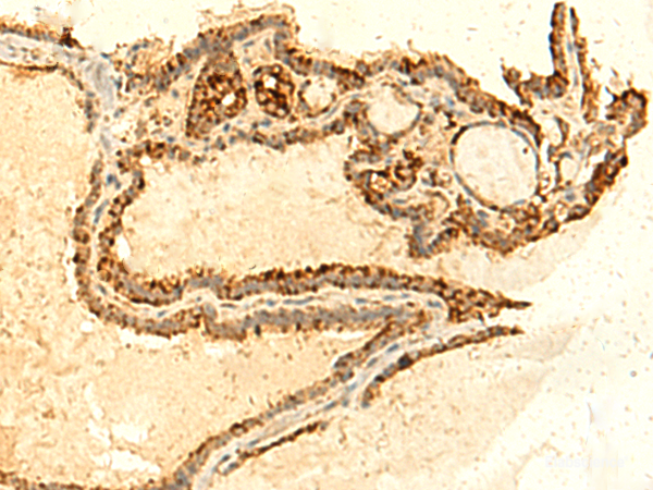 Immunohistochemistry of paraffin-embedded Human thyroid cancer tissue using UNKL Polyclonal Antibody at dilution of 1:50(×200)