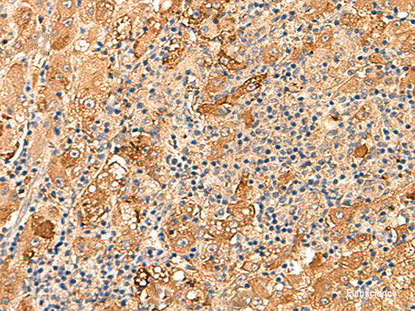 Immunohistochemistry of paraffin-embedded Human liver cancer tissue using KCNE3 Polyclonal Antibody at dilution of 1:60(×200)