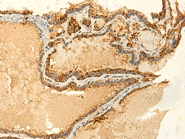 Immunohistochemistry of paraffin-embedded Human thyroid cancer tissue using GLYATL2 Polyclonal Antibody at dilution of 1:50(×200)
