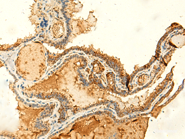 Immunohistochemistry of paraffin-embedded Human thyroid cancer tissue using KIAA0513 Polyclonal Antibody at dilution of 1:50(×200)