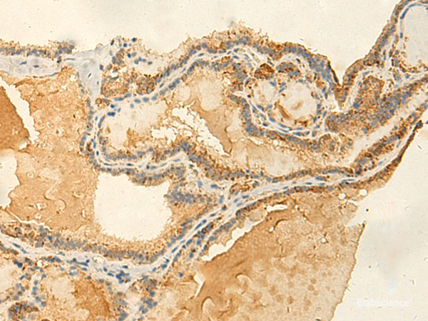 Immunohistochemistry of paraffin-embedded Human thyroid cancer tissue using RNF148 Polyclonal Antibody at dilution of 1:50(×200)
