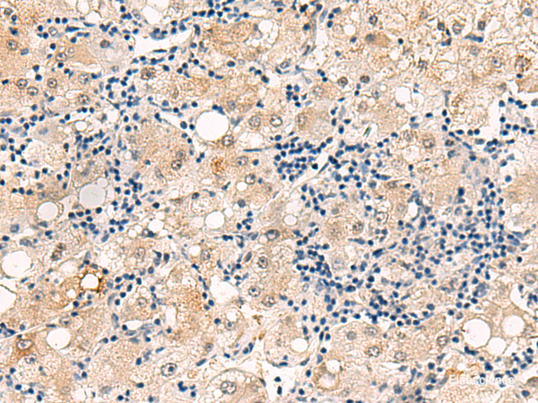 Immunohistochemistry of paraffin-embedded Human liver cancer tissue using DUSP7 Polyclonal Antibody at dilution of 1:50(×200)