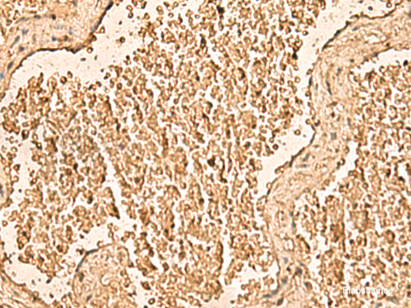 Immunohistochemistry of paraffin-embedded Human gastric cancer tissue using WDR33 Polyclonal Antibody at dilution of 1:50(×200)