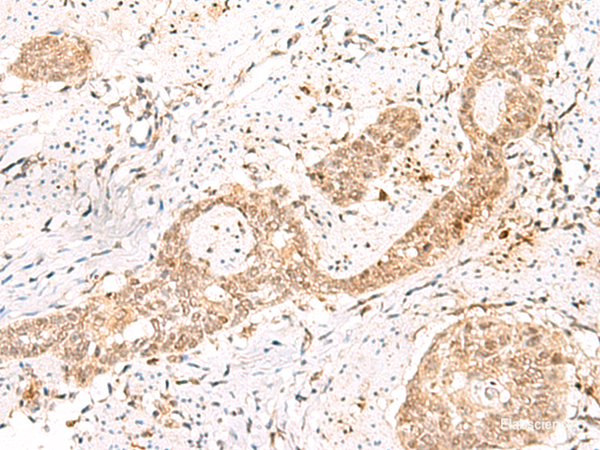 Immunohistochemistry of paraffin-embedded Human esophagus cancer tissue using PRKAG2 Polyclonal Antibody at dilution of 1:55(×200)
