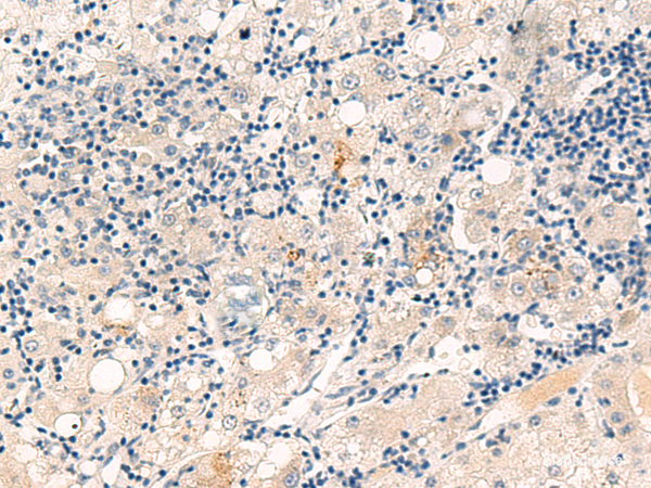 Immunohistochemistry of paraffin-embedded Human liver cancer tissue using CYYR1 Polyclonal Antibody at dilution of 1:55(×200)
