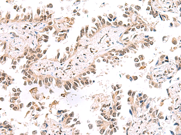 Immunohistochemistry of paraffin-embedded Human lung cancer tissue using KCTD13 Polyclonal Antibody at dilution of 1:50(×200)