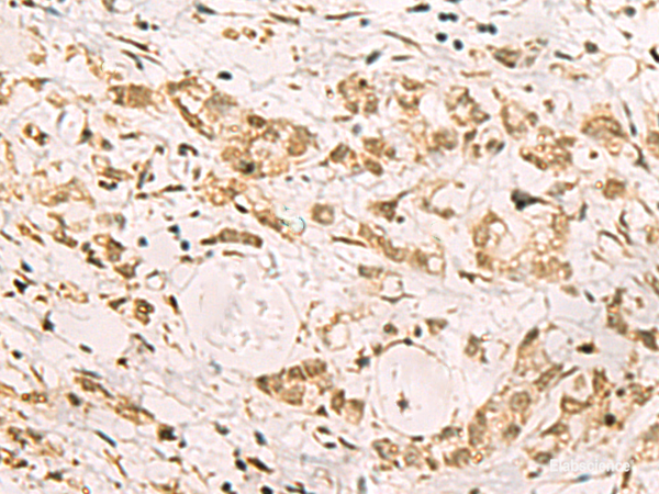 Immunohistochemistry of paraffin-embedded Human gastric cancer tissue using PDS5A Polyclonal Antibody at dilution of 1:90(×200)