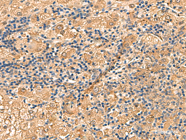 Immunohistochemistry of paraffin-embedded Human liver cancer tissue using PTH1R Polyclonal Antibody at dilution of 1:55(×200)