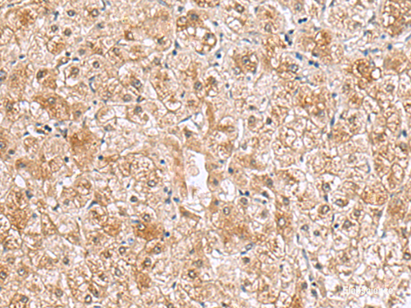 Immunohistochemistry of paraffin-embedded Human liver cancer tissue using RTKN2 Polyclonal Antibody at dilution of 1:70(×200)
