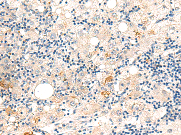 Immunohistochemistry of paraffin-embedded Human liver cancer tissue using DUT Polyclonal Antibody at dilution of 1:60(×200)