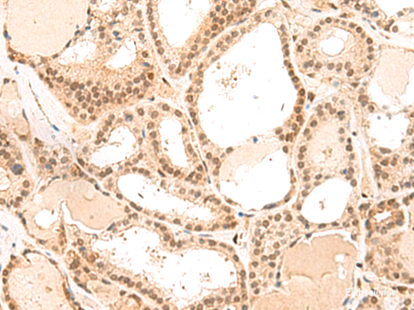 Immunohistochemistry of paraffin-embedded Human thyroid cancer tissue using MKX Polyclonal Antibody at dilution of 1:50(×200)
