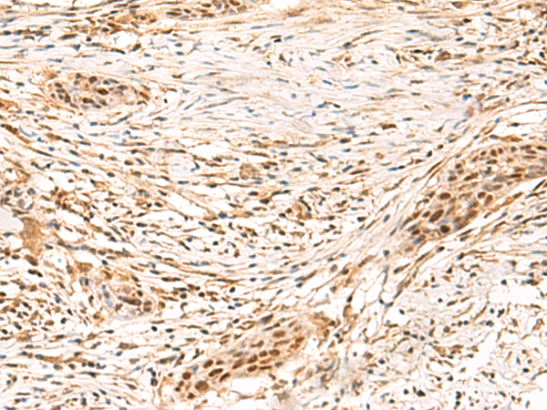 Immunohistochemistry of paraffin-embedded Human esophagus cancer tissue using SETMAR Polyclonal Antibody at dilution of 1:100(×200)