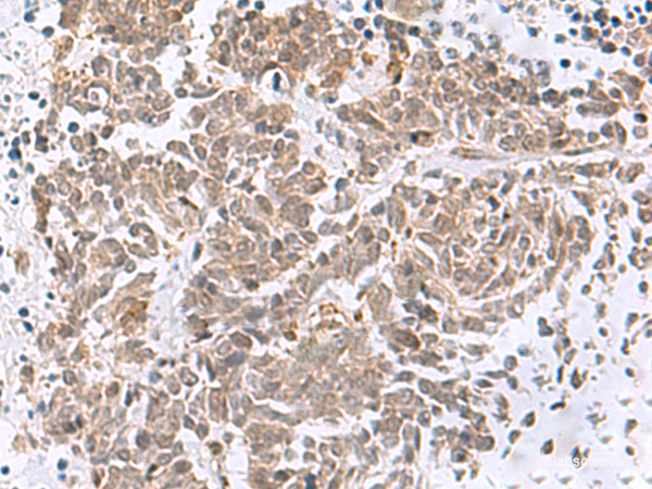 Immunohistochemistry of paraffin-embedded Human lung cancer tissue using RBFOX2 Polyclonal Antibody at dilution of 1:50(×200)