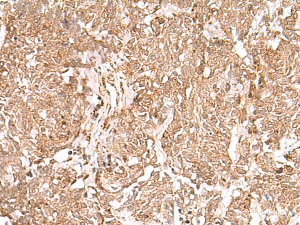 Immunohistochemistry of paraffin-embedded Human lung cancer tissue using GMPPB Polyclonal Antibody at dilution of 1:50(×200)