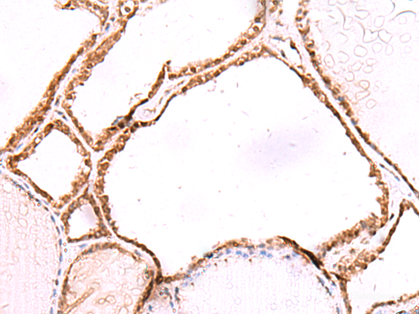 Immunohistochemistry of paraffin-embedded Human thyroid cancer tissue using LMCD1 Polyclonal Antibody at dilution of 1:80(×200)