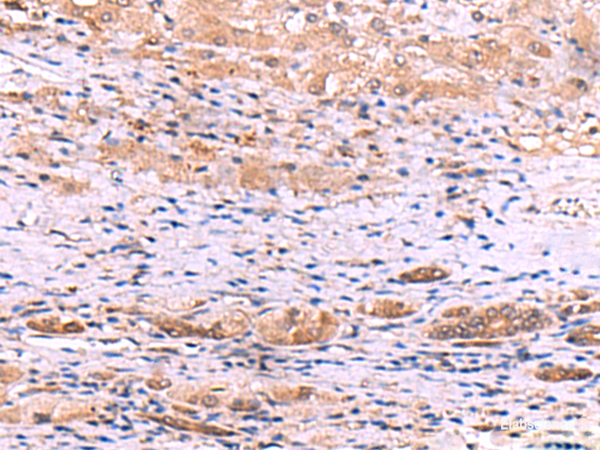Immunohistochemistry of paraffin-embedded Human liver cancer tissue using DHPS Polyclonal Antibody at dilution of 1:55(×200)