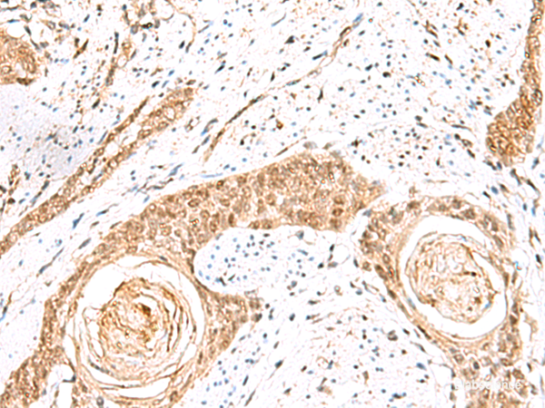 Immunohistochemistry of paraffin-embedded Human esophagus cancer tissue using ELF3 Polyclonal Antibody at dilution of 1:60(×200)