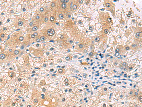 Immunohistochemistry of paraffin-embedded Human liver cancer tissue using RNF13 Polyclonal Antibody at dilution of 1:60(×200)