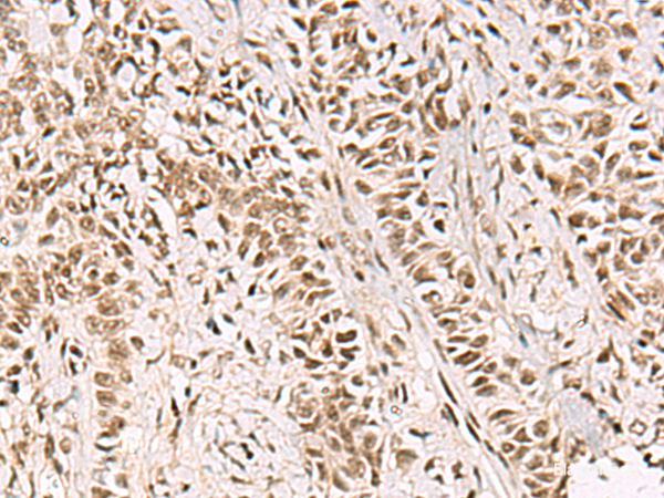 Immunohistochemistry of paraffin-embedded Human ovarian cancer tissue using GABPB1 Polyclonal Antibody at dilution of 1:55(×200)