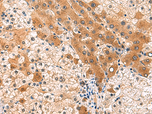 Immunohistochemistry of paraffin-embedded Human liver cancer tissue using PCYT2 Polyclonal Antibody at dilution of 1:85(×200)