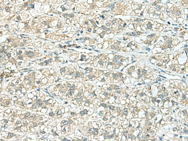 Immunohistochemistry of paraffin-embedded Human liver cancer tissue using TENT5C Polyclonal Antibody at dilution of 1:110(×200)