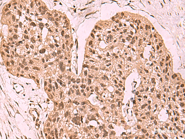 Immunohistochemistry of paraffin-embedded Human esophagus cancer tissue using SETDB1 Polyclonal Antibody at dilution of 1:60(×200)
