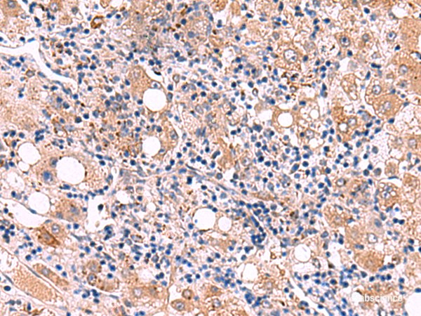 Immunohistochemistry of paraffin-embedded Human liver cancer tissue using LIPA Polyclonal Antibody at dilution of 1:50(×200)