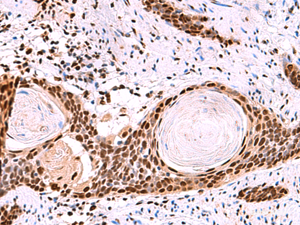 Immunohistochemistry of paraffin-embedded Human esophagus cancer tissue using SF3B3 Polyclonal Antibody at dilution of 1:50(×200)