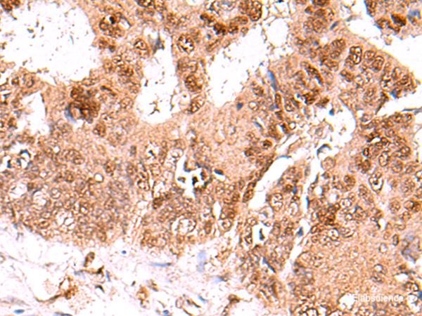 Immunohistochemistry of paraffin-embedded Human colorectal cancer tissue using FDPS Polyclonal Antibody at dilution of 1:60(×200)