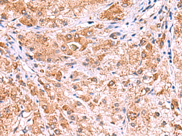 Immunohistochemistry of paraffin-embedded Human liver cancer tissue using UXS1 Polyclonal Antibody at dilution of 1:60(×200)