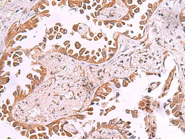 Immunohistochemistry of paraffin-embedded Human lung cancer tissue using AK9 Polyclonal Antibody at dilution of 1:85(×200)