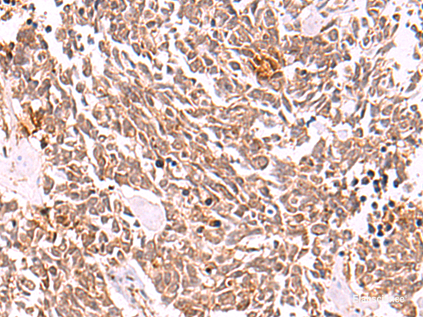Immunohistochemistry of paraffin-embedded Human lung cancer tissue using COPS3 Polyclonal Antibody at dilution of 1:50(×200)