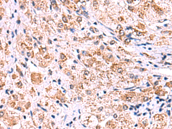 Immunohistochemistry of paraffin-embedded Human liver cancer tissue using ECSIT Polyclonal Antibody at dilution of 1:75(×200)