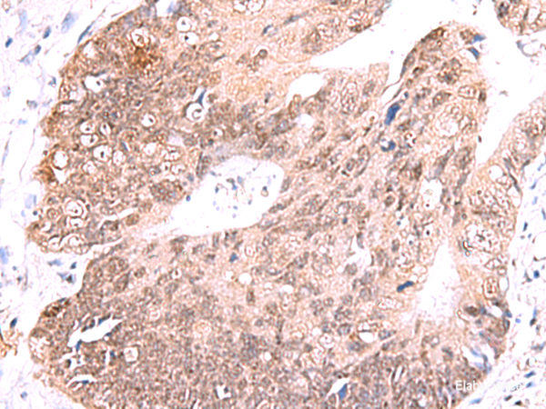 Immunohistochemistry of paraffin-embedded Human colorectal cancer tissue using RUSC1 Polyclonal Antibody at dilution of 1:65(×200)