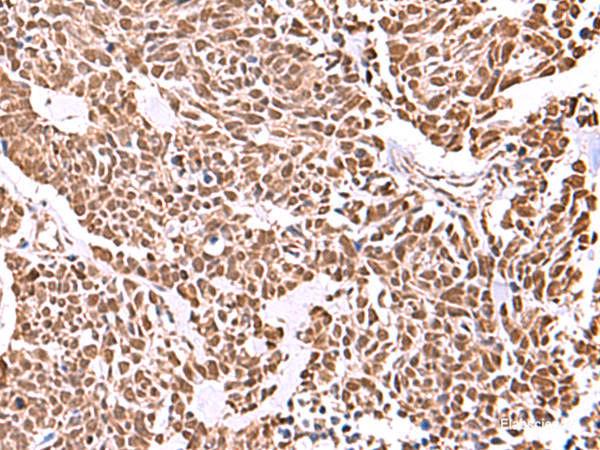 Immunohistochemistry of paraffin-embedded Human lung cancer tissue using RCOR3 Polyclonal Antibody at dilution of 1:55(×200)